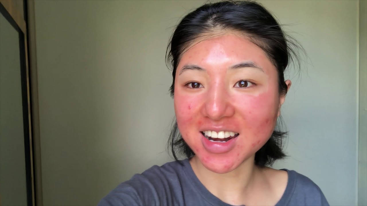 My first chemical peel experience - COSMELAN TREATMENT BY MESOESTETIC