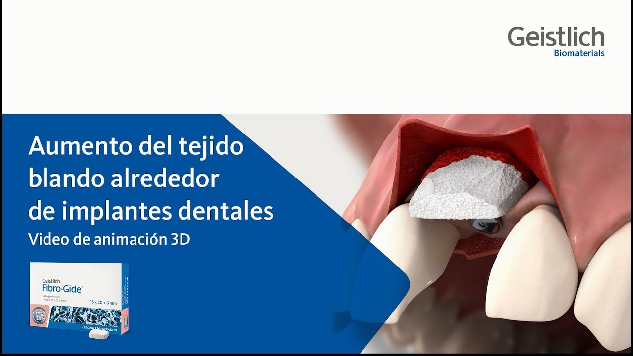 Geistlich Fibro-Gide&reg; - Aumento del tejido blando
