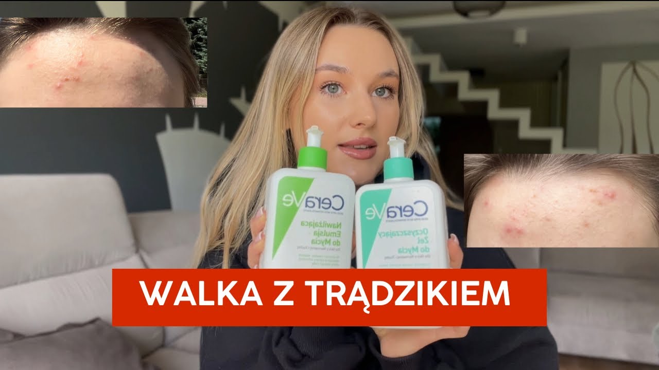 Trądzik a samoocena 🫢 | Moja „przygoda” z trądzikiem…