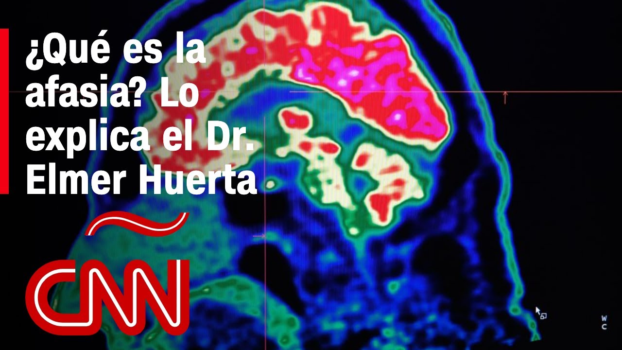 La afasia, condición médica que padece Bruce Willis, dificulta la comunicación, dice el Dr. Huerta