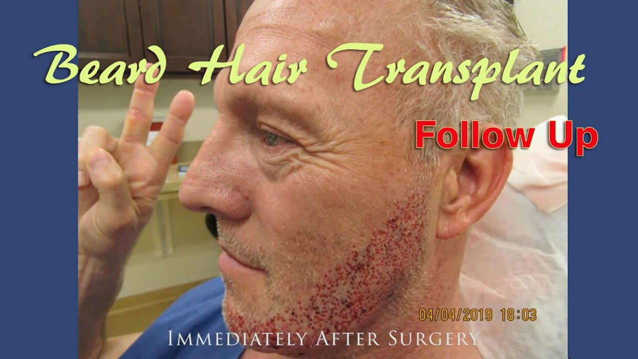 Beard Hair Transplant Results at McGrath Medical