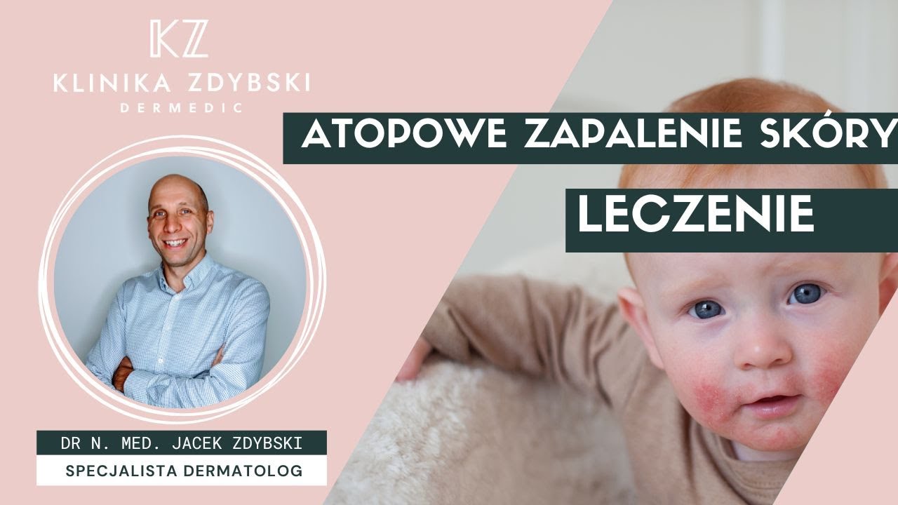 Dermatolog mówi o: Atopowe Zapalenie Skóry - leczenie AZS