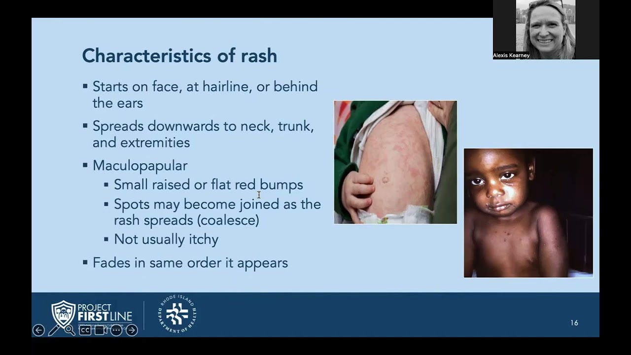 Measles in Healthcare Settings: An Infection Prevention and Control Refresher