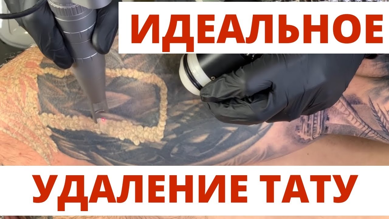 ИДЕАЛЬНОЕ УДАЛЕНИЕ ТАТУ лазером за 5 МЛН РУБЛЕЙ! ПРАВИЛЬНОЕ лазерное удаление.