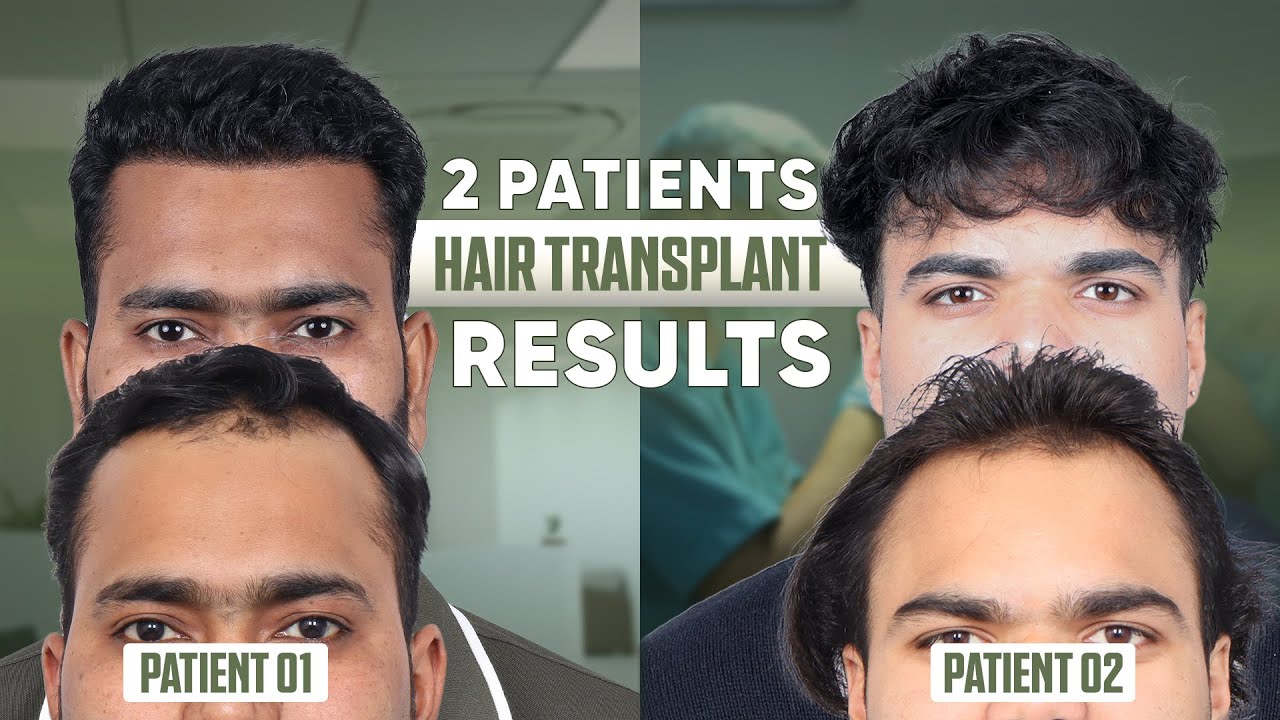 Hair Transplant in Patna  | Best Results & Cost of Hair Transplant in Patna