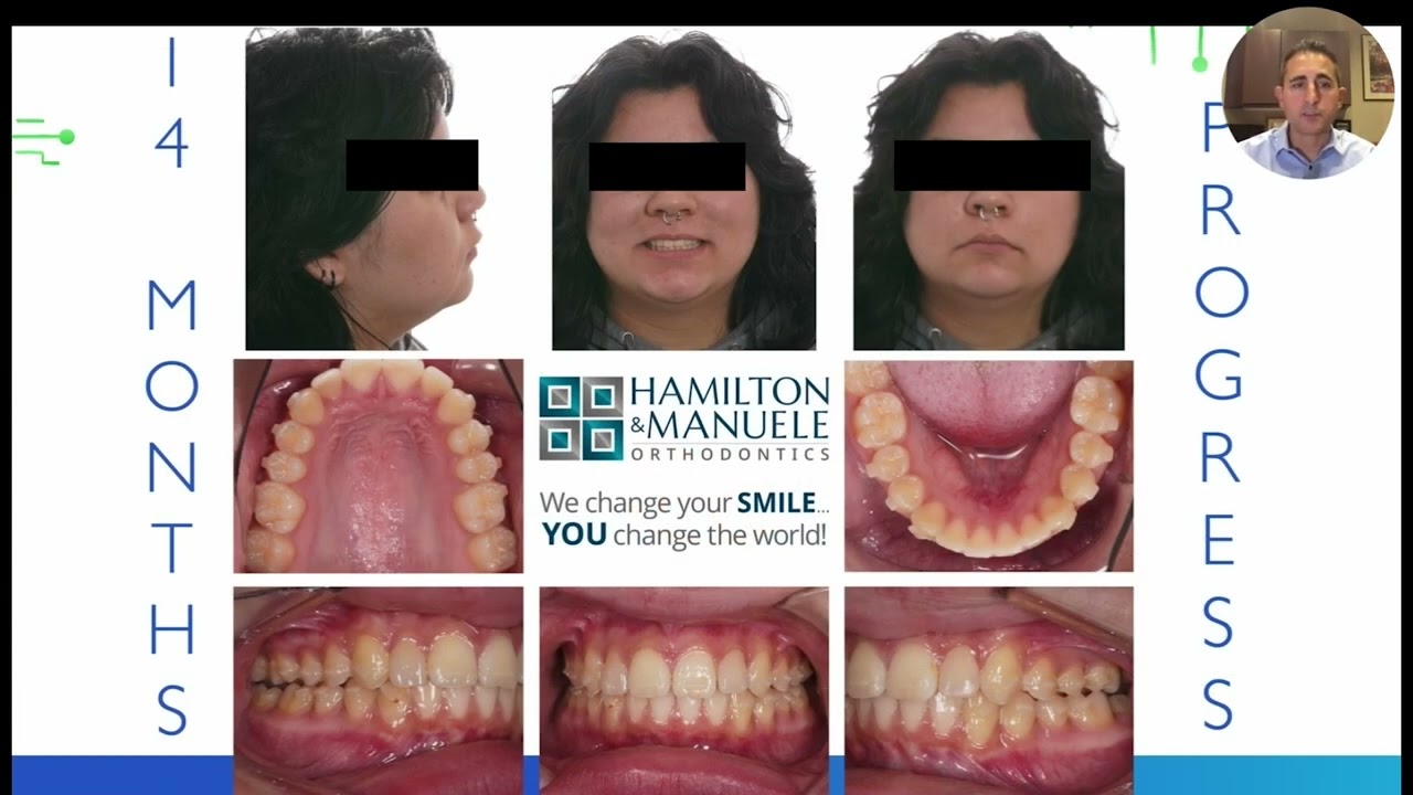 Webinar Clips: Class II Crowding with Motion Appliance and Aligners