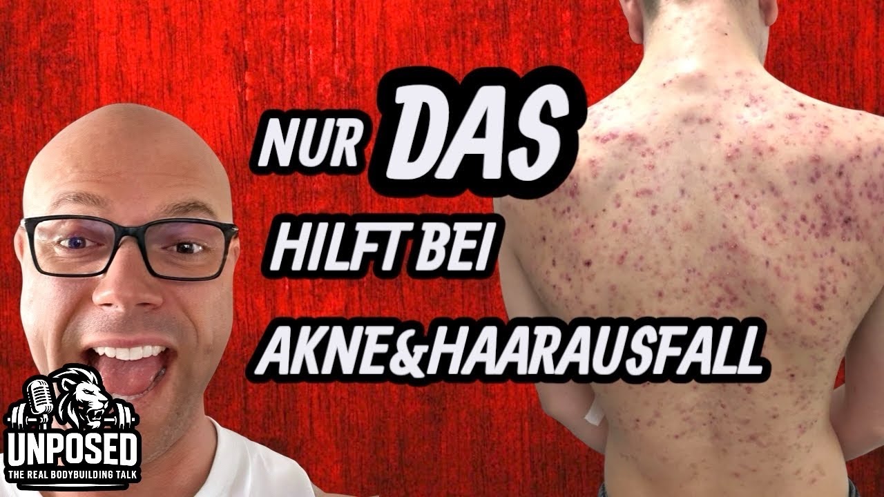 Unposed Ep.3 - Haarausfall & Akne