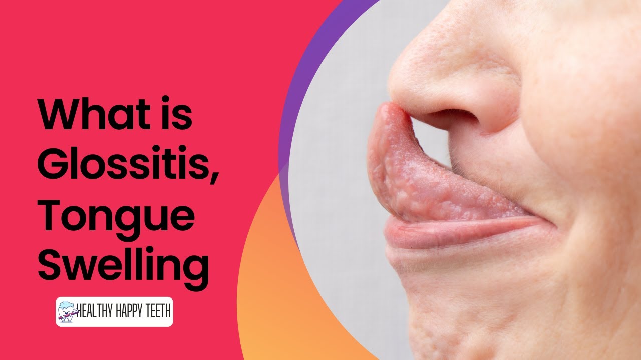 What is Tongue Swelling? What is Glossitis?