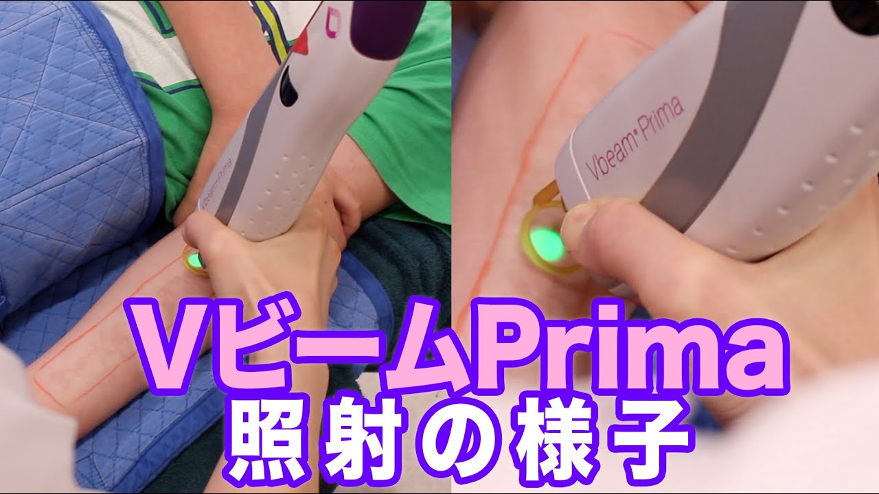【西堀形成外科】照射の様子　VビームPrima