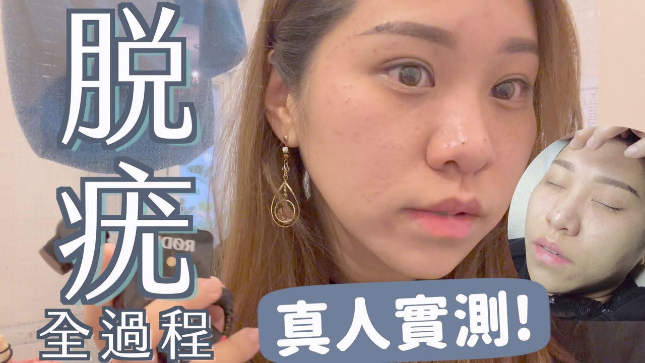 實測🔥移居前/婚前/女人必做-脫疣！幾錢💰？唔痛😳？什麼是疣？男士都會有疣！是皮膚病的一種.... |  Ruby 餅神Benson