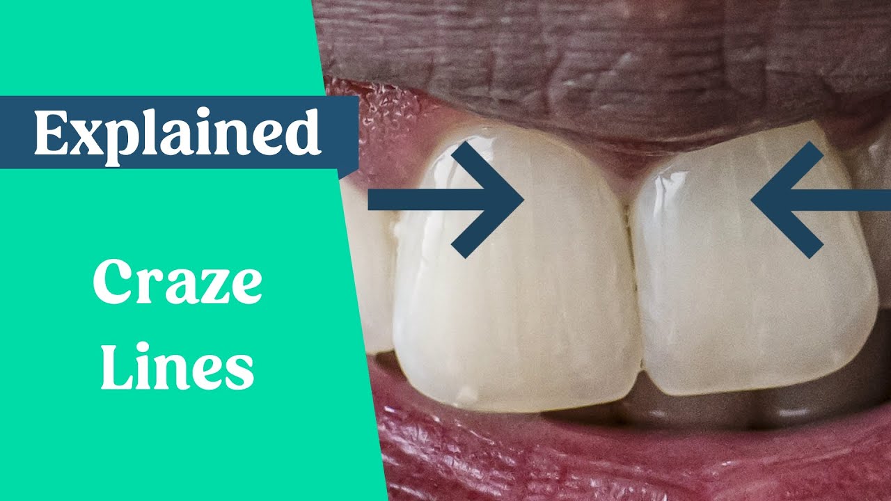 What are craze lines?