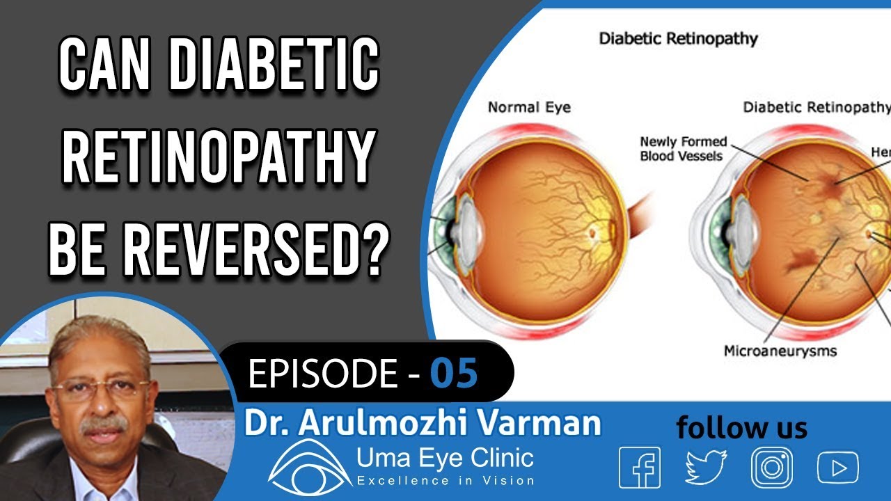 Diabetes Retinopathy | Can Diabetic Retinopathy Be Reversed? | Dr Arulmozhi Varman | EPI 05