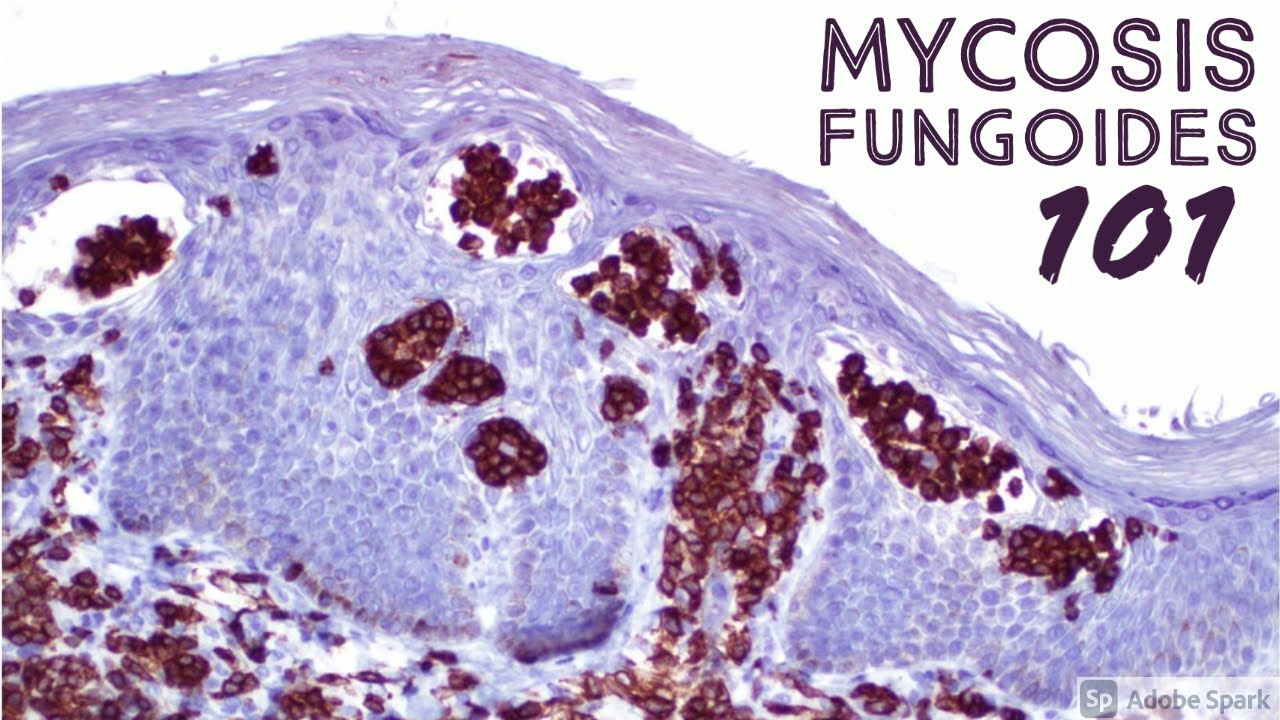 Mycosis Fungoides 101 (Cutaneous T-cell Lymphoma CTCL for Dermatopathology Pathology Dermatology)