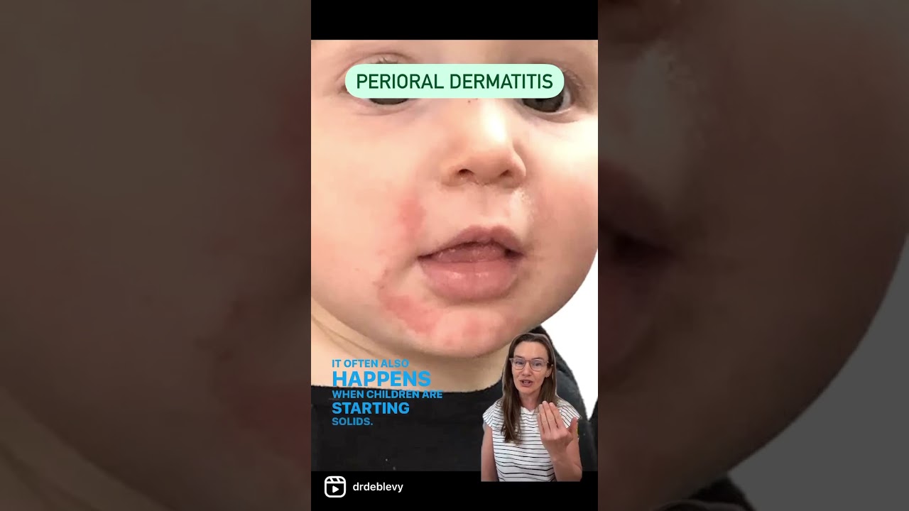 PERIORAL DERMATITIS #shorts #pediatrician #healthinfo