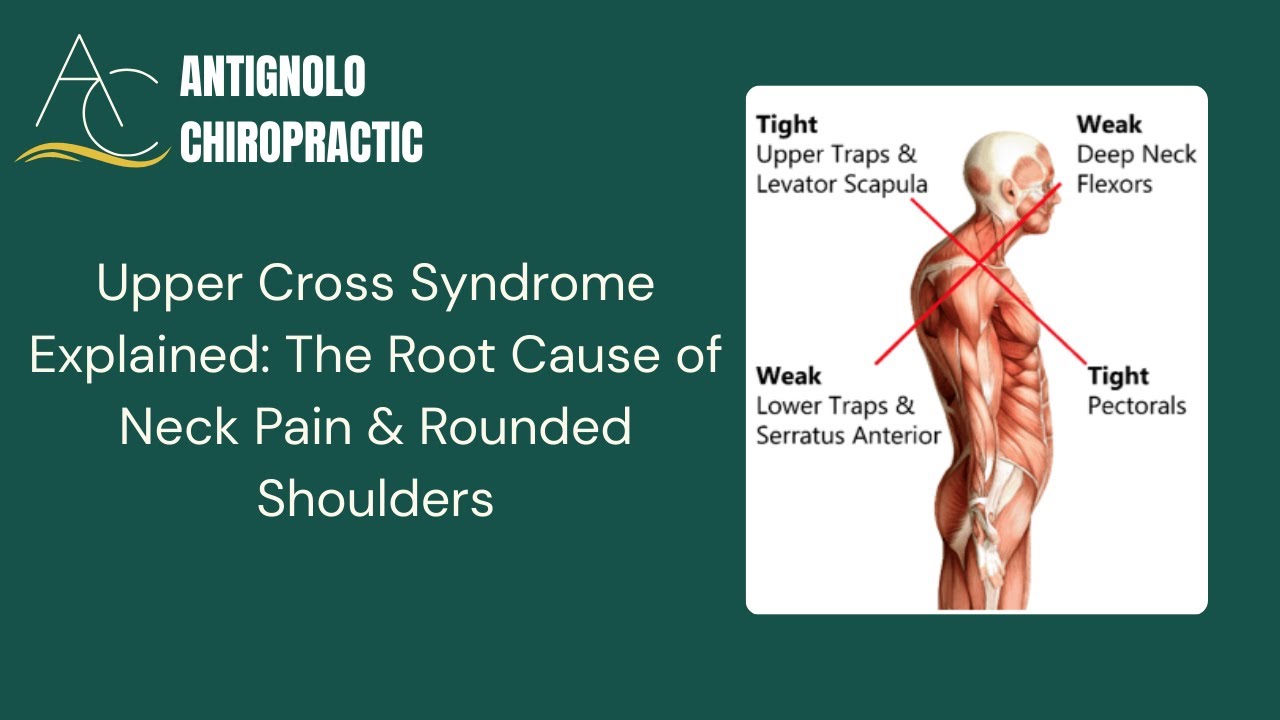 Neck Posture Explained! What is Upper Cross Syndrome? Learn more today.