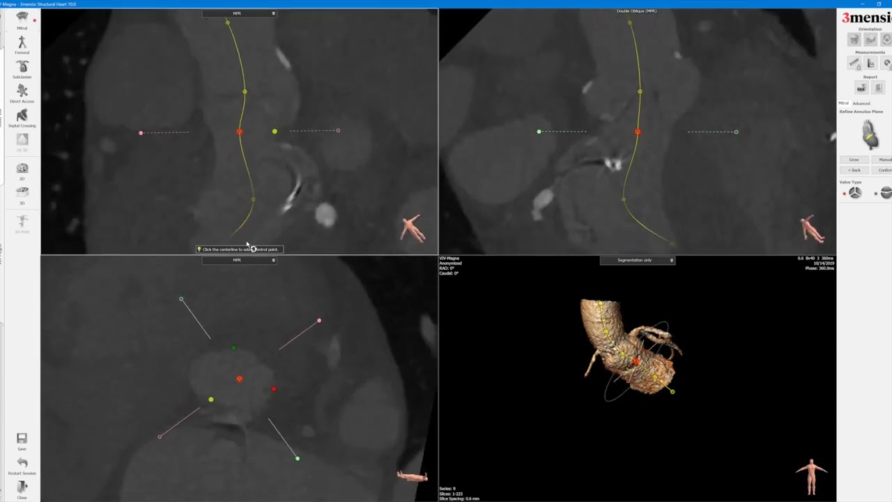 3Mensio CT Pre-case Planning: Mitral Valve-in-Valve TMVR in Magna Valve