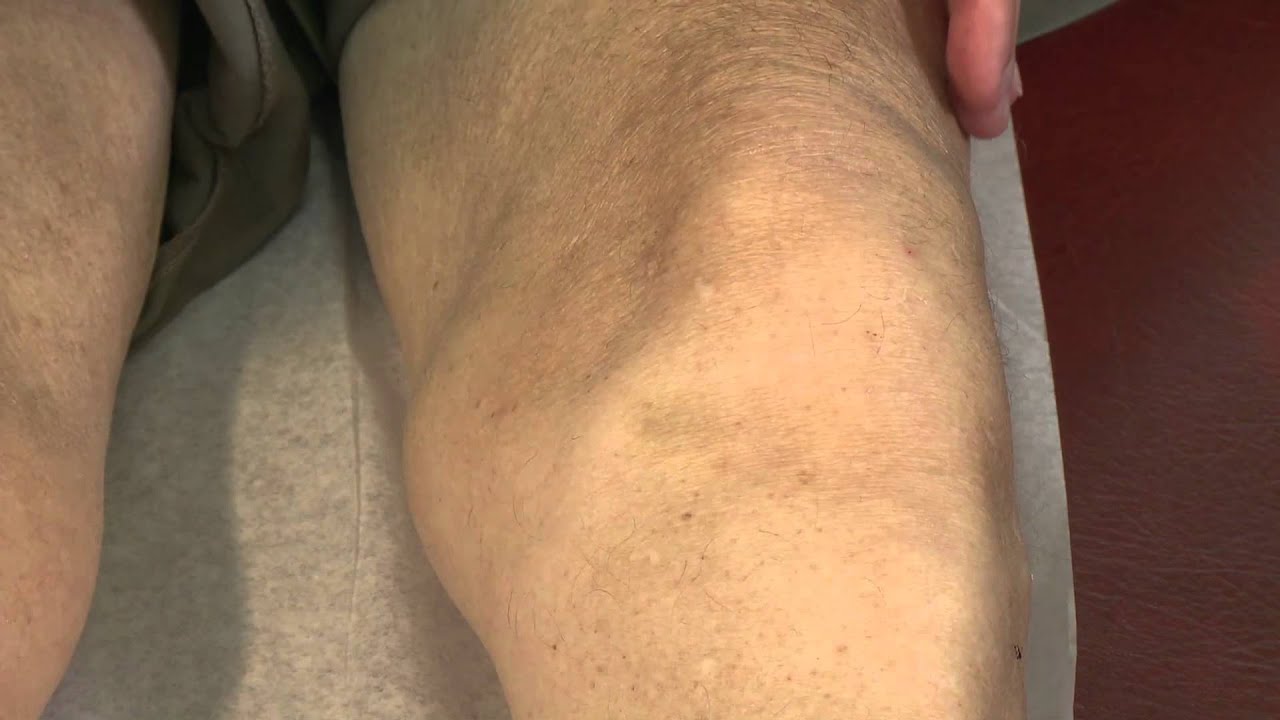 Effusion - Bulge Sign