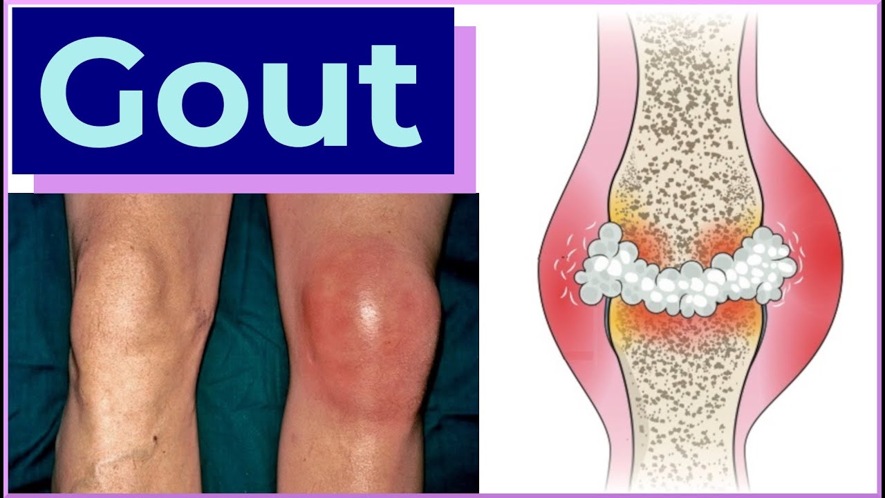 Gout of the Knee