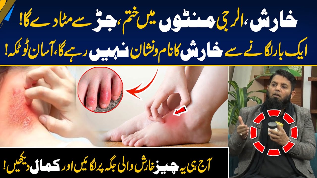 Itching Gone in Minutes - Herbal Solution - Easy & Powerful Remedies for Psoriasis