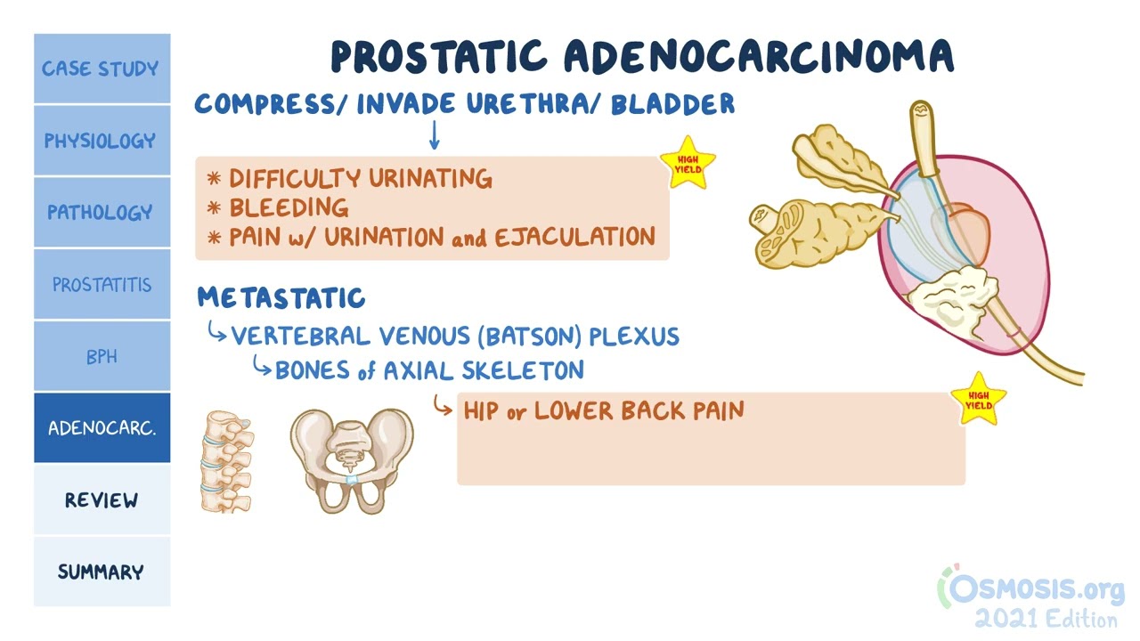 Prostate disorders