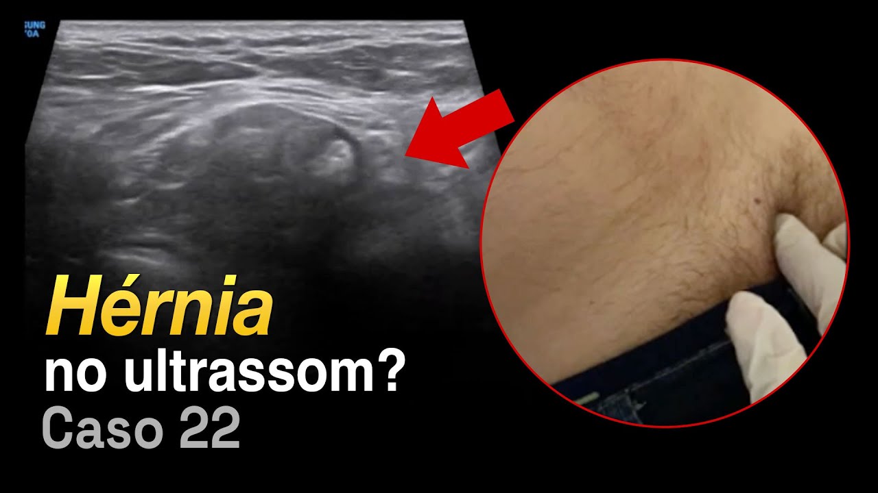 Hérnia no Ultrassom: Direta ou Indireta? | Caso 022 - PHD