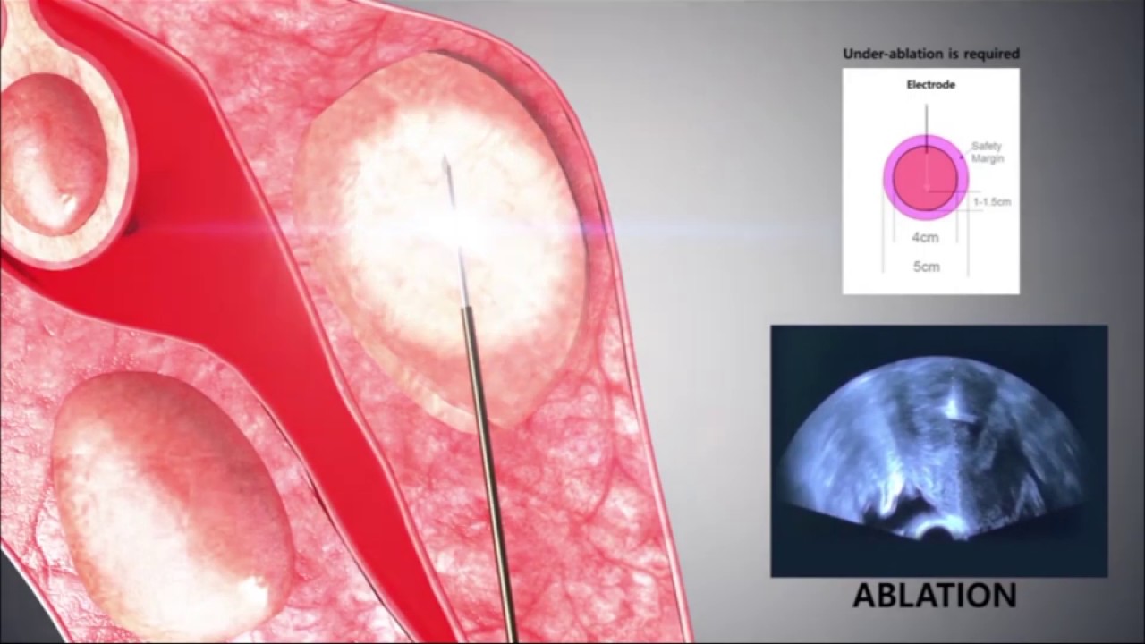 Mioma Uterino: Ablación por radiofrecuencia (RFA)