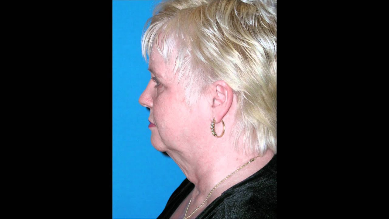 NASHVILLE FACELIFT AND BROWLIFT PLASTIC SURGERY BEFORE AND AFTERS
