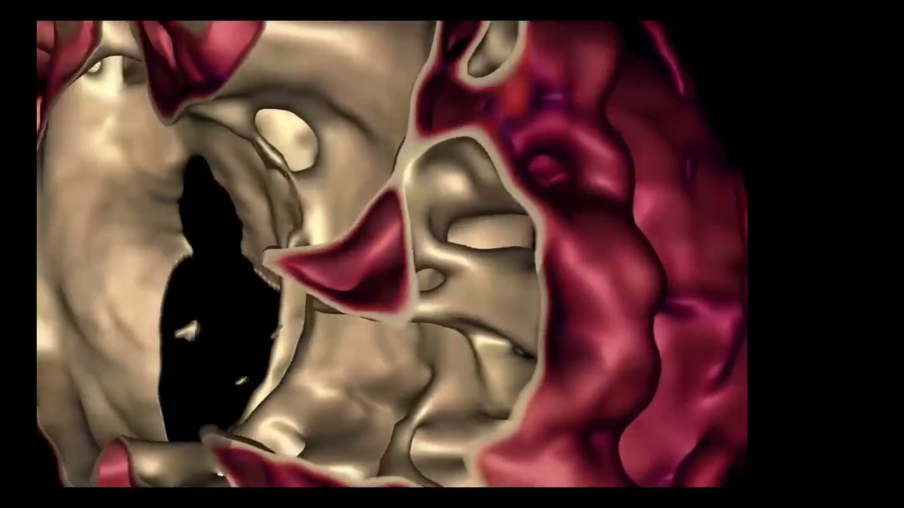 Visualization to Inform Surgical Approach to Closure of Single Large Apical Muscular VSD (Case 1)
