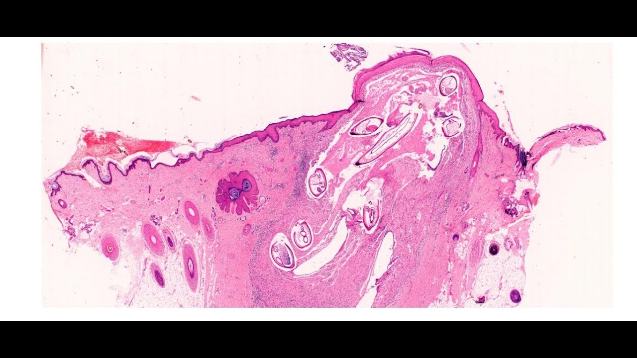 Parasites - Onchocercoma -  Digipath Tutorials