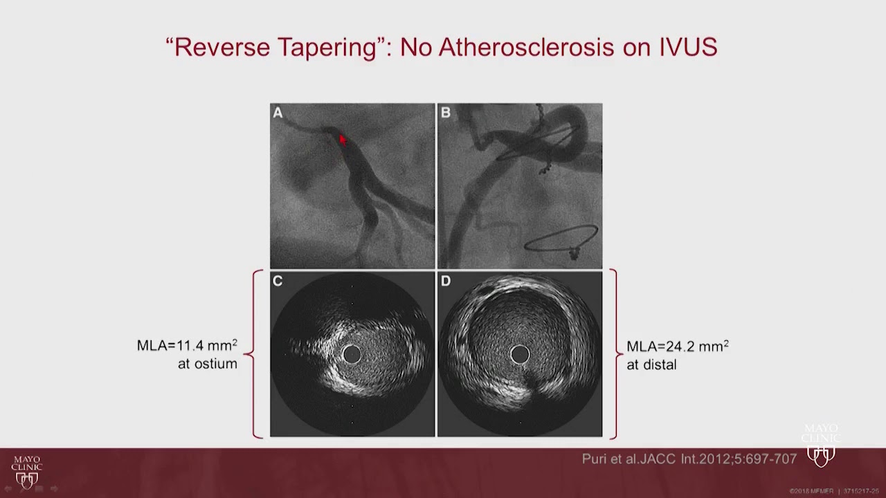 Left Main and Bifurcation Disease intervention