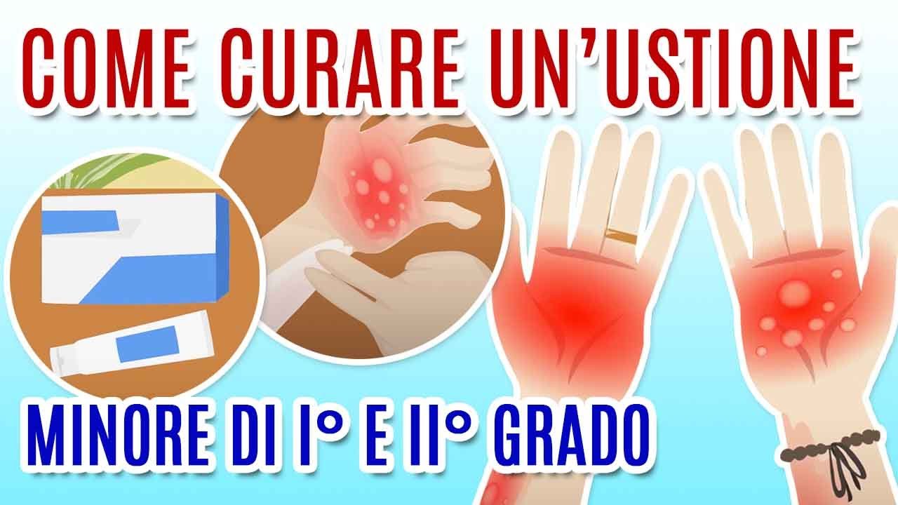 COME CURARE LE USTIONI?
