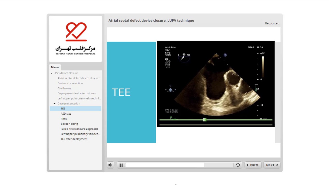 Large ASD device closure:  LUPV technique