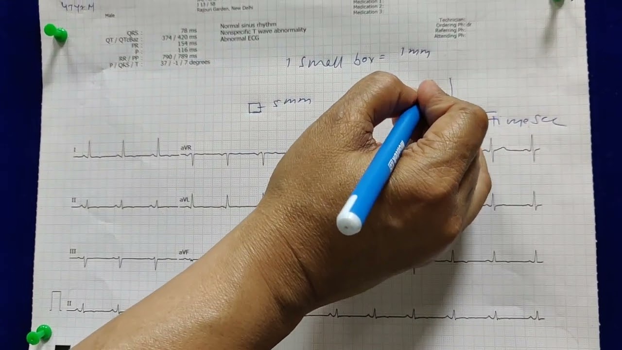 ECG PAPER/ ELECTROCARDIOGRAM @ DR SEEMA KALE