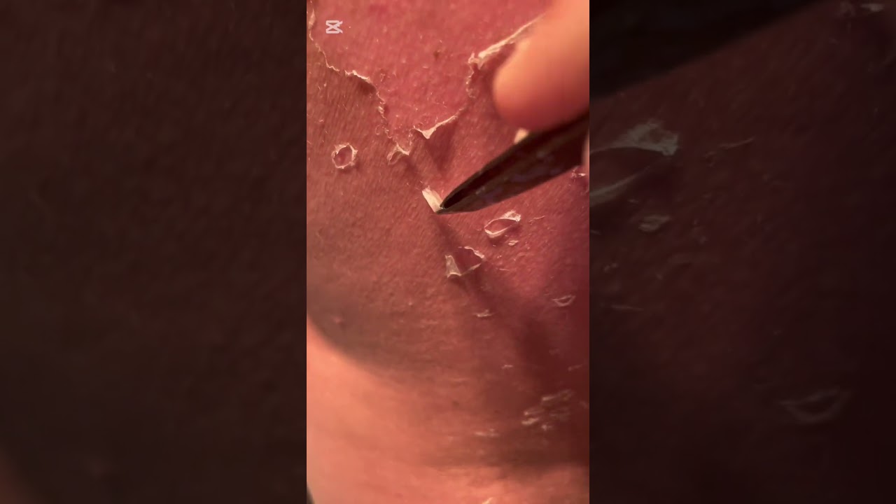 Huge and Crispy Skin Peel - Day 2