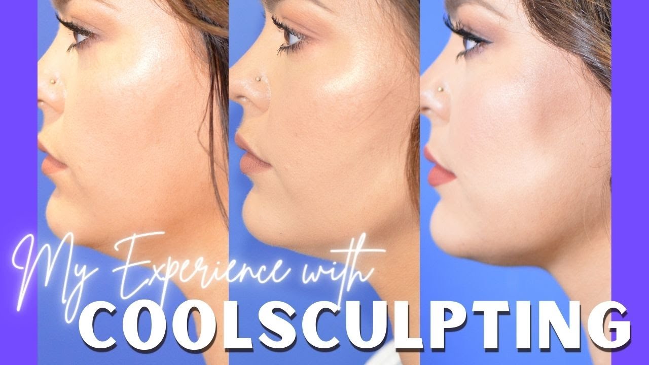 Мой опыт CoolSculpting | Вопросы и ответы и результаты