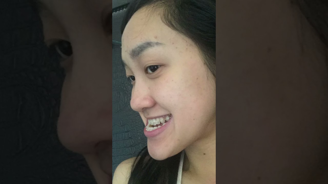 how braces and jaw surgery CHANGED MY FACE 😦🤯… 