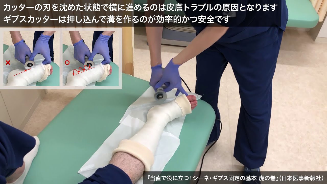 動画7「ギプスカット：右下肢をギプスカットしている様子」