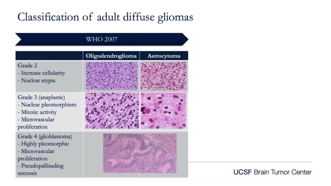 History of Brain Tumor Classification and Discovery of the IDH Mutation | UCSF Brain Tumor Center
