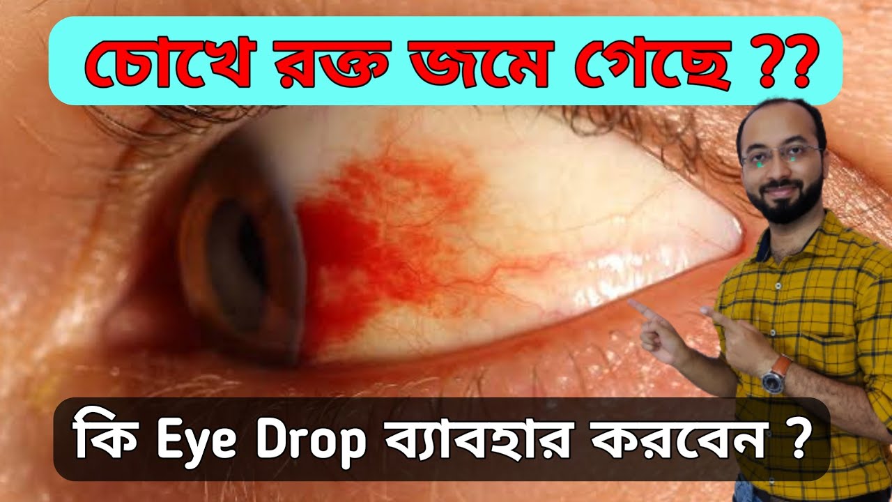চোখের সাদা অংশে রক্ত ​​জমাট বাঁধার চিকিৎসা | Blood clot in eyes treatment | চোখে রক্ত জমলে করনীয়