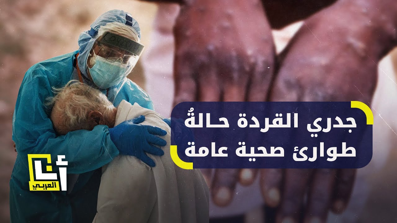 بعد ركوده لعقود، جدري القردة ينتشر بسرعة في إفريقيا ويظهر في بلدان خارجها
