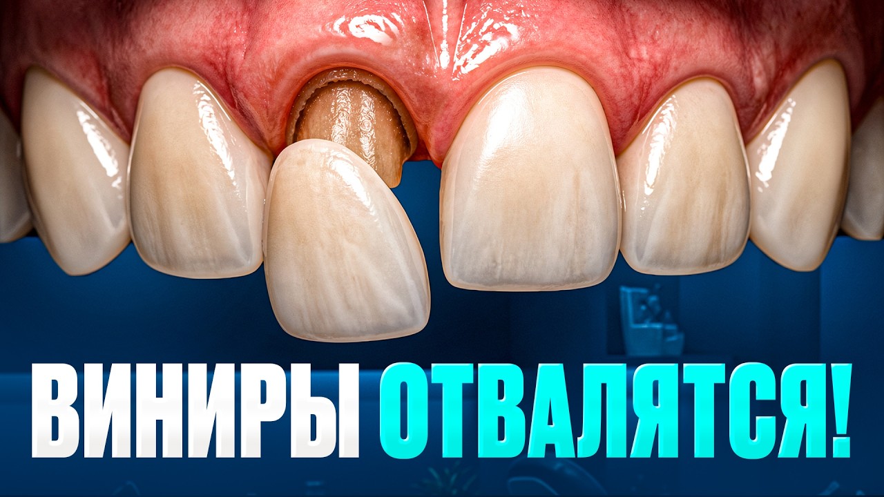 Что должно быть сделано до установки виниров?