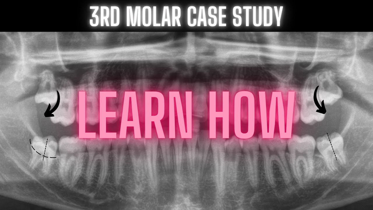 Third Molar Impaction Video | Learn How | OnlineExodontia.com