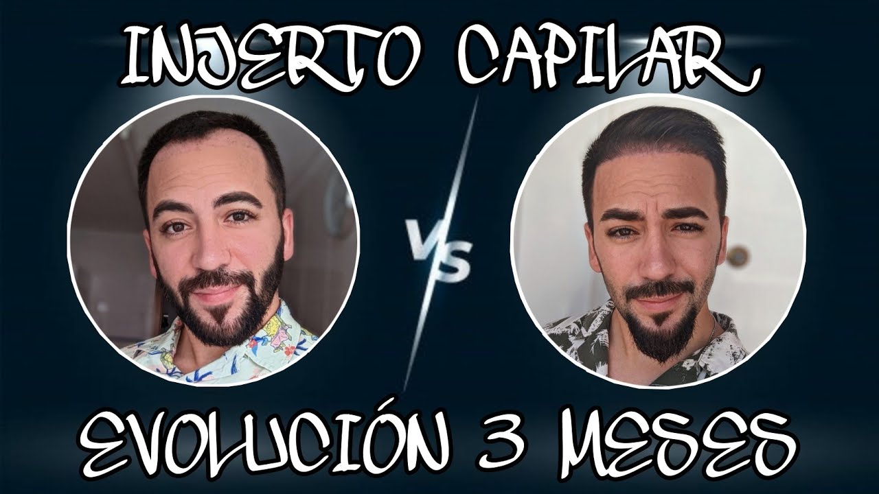 #19.- EVOLUCIÓN TRASPLANTE CAPILAR mes a mes/ MES 3