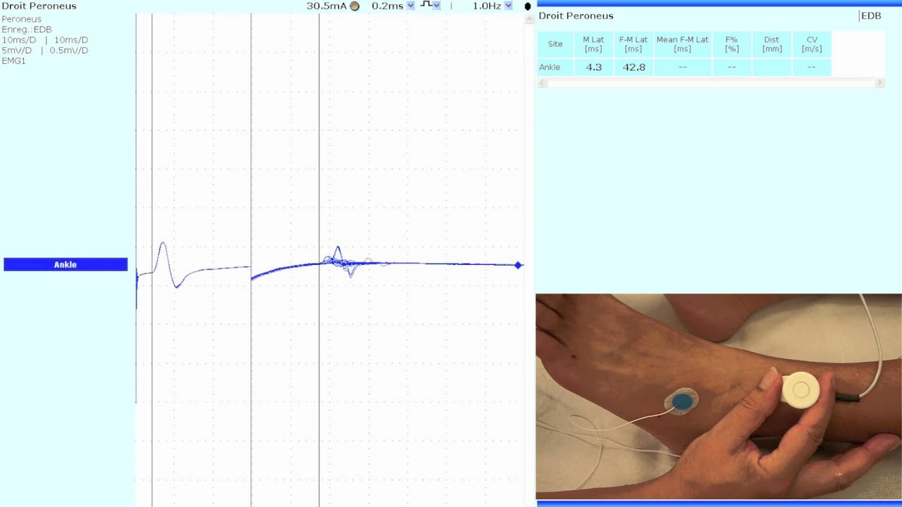 Nerf fibulaire (neurographie motrice : r&eacute;ponses M et F)