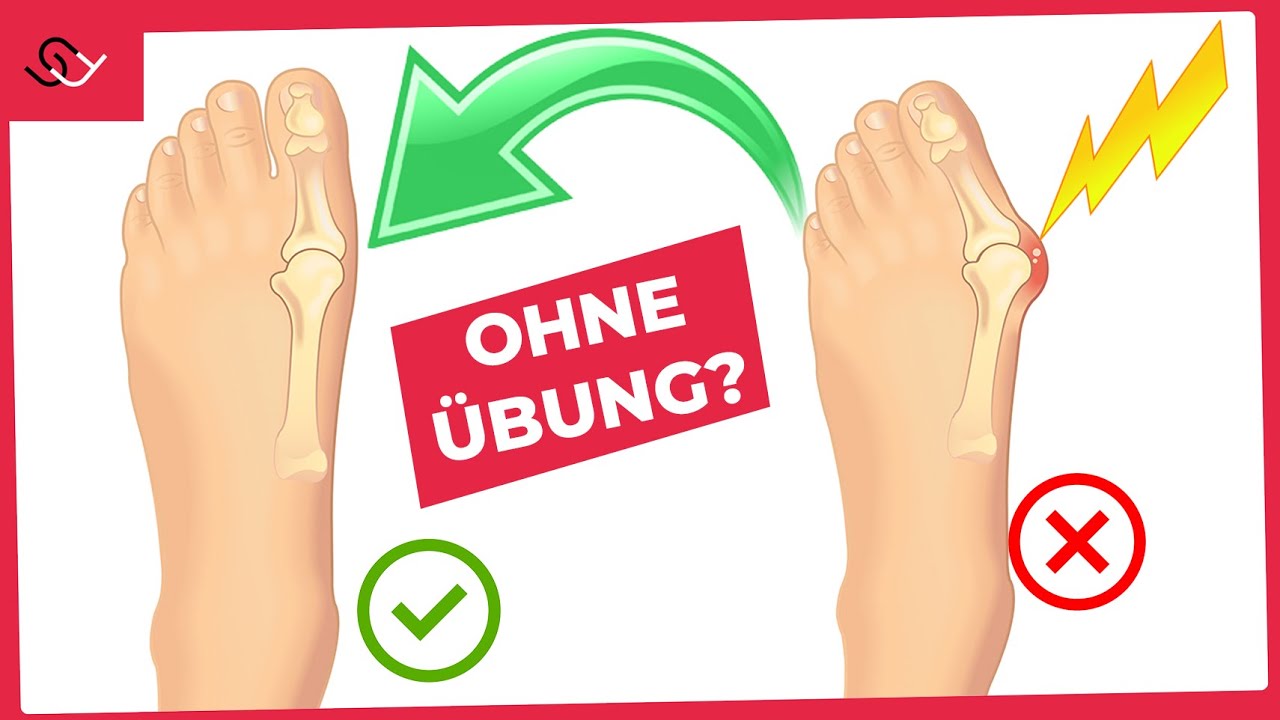 Hallux Valgus und Fußschmerzen los werden - ohne Übung