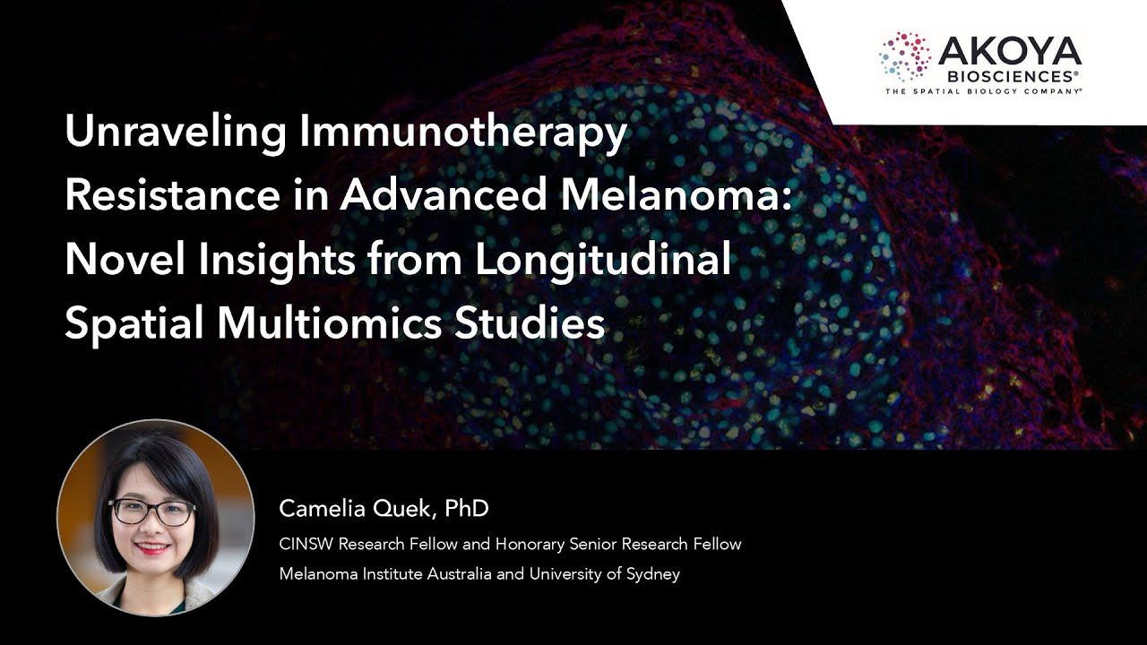 Immunotherapy Resistance in Advanced Melanoma: Insights from Longitudinal Spatial Multiomics Studies