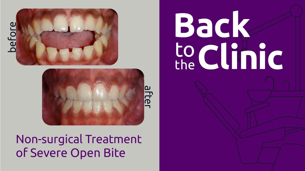 Non-surgical Treatment of Severe Open Bite - Back to the Clinic #004