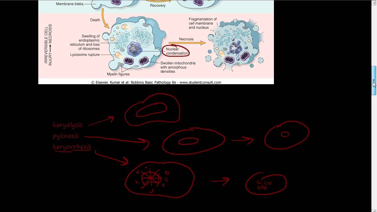 #8 - Micro and Macro morphology of necrosis - karyolysis, pyknosis, karyorrhexis, necrosis.