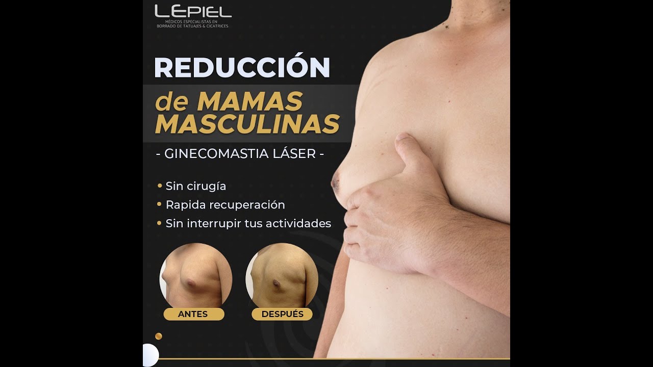 Entrevista Elimina la falsa Ginecomastia  mamas masculinas