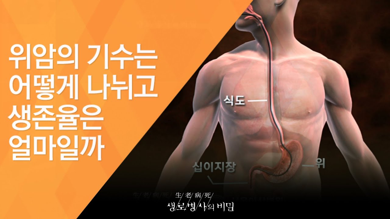 위암의 기수는 어떻게 나뉘고 생존율을 얼마일까 - (20120218_402회 방송)_위를 위하여